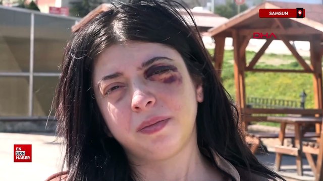 Samsun'da sokak ortasında darbedilen Damla: 3 ay sıvı ile besleneceğim