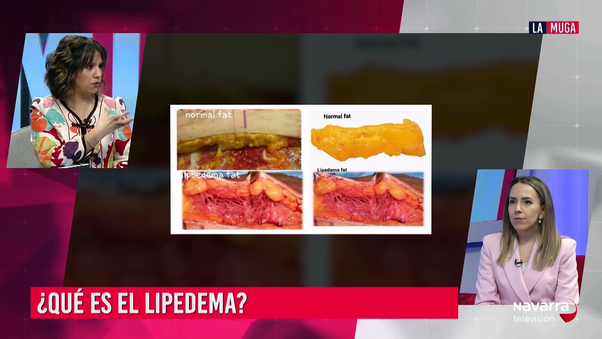 El lipedema, qué es y cómo tratarlo con la nutricionista Raquel Ortega