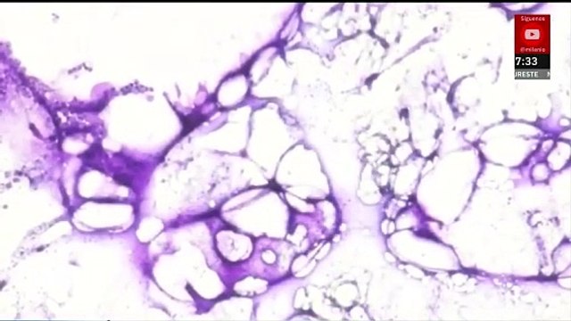 Autoridades alertan por aumento de sarampión en México por casos importados