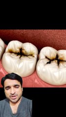 Dental caries | dental decay | dant min keeda |