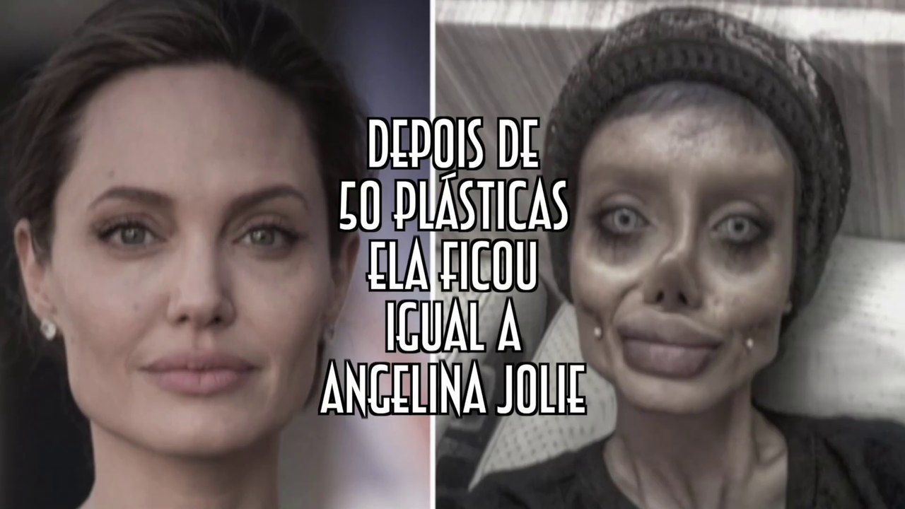 Depois de 50 plásticas ela ficou igual a Angelina Jolie - EMVB - Emerson Martins Video Blog 2017