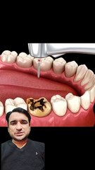 Dental crown | tooth cap | tooth cover |