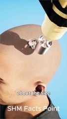 "Neuralink Brain Implant:First Human Installation & Future of Mind-Tech Integration!"#shorts #shortsfeed #short #trending