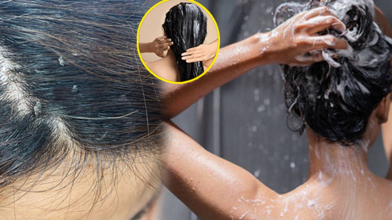 What To Do To Avoid Dandruff : डैंड्रफ होने पर क्या नहीं करना चाहिए,Hair Oiling To Shampoo..