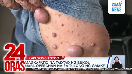 Kapusong Totoo: Mga may bukol sa katawan, napa-operahan; at libreng N95 face mask para Batangas | 24 Oras