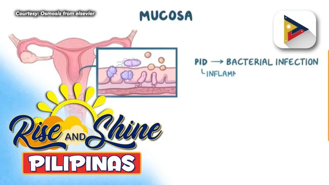 Say ni DOK | Pelvic inflammatory disease, maaaring maging sanhi ng infertility!