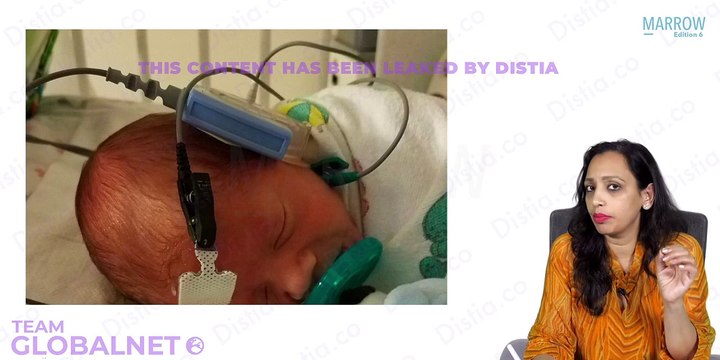 10. Audiology and Evaluation: Tuning Fork Tests