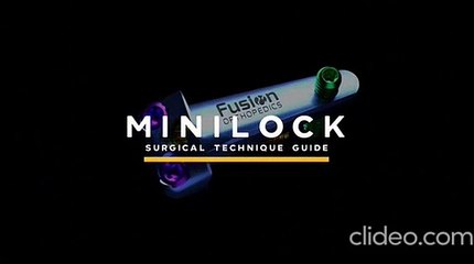 Best MiniLock Service Provider in the USA – Advanced Bunion Correction Experts