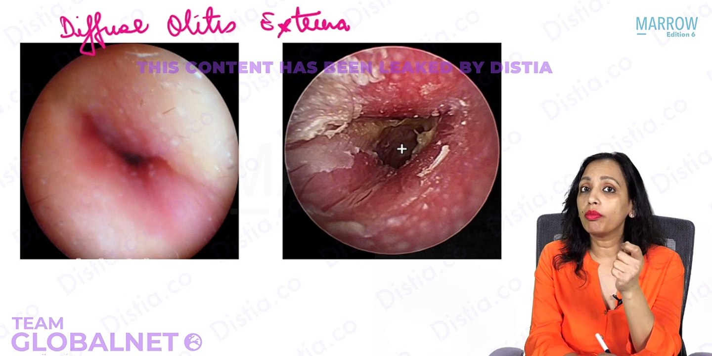 17. Disease of eac