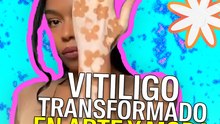 Esta influencer transformó su vitíligo en arte