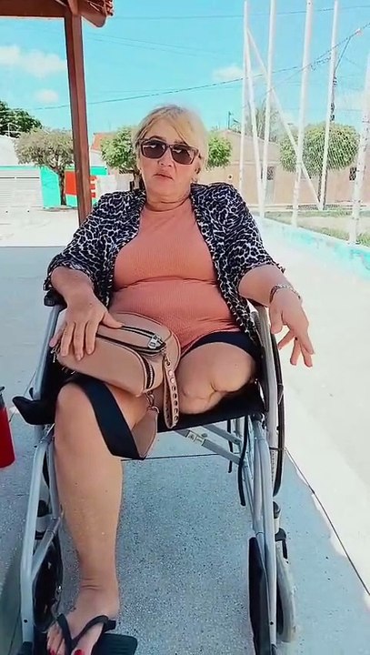 Moradora de Malta-PB busca ajuda para conseguir prótese mecânica e realizar sonho de voltar a andar