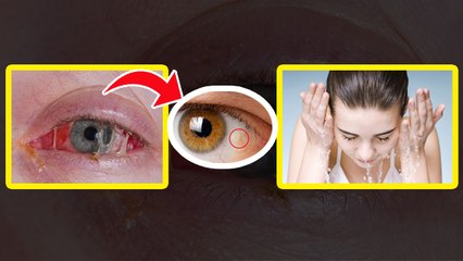 Eye Allergy Treatment: आंखों की Allergies से बचने के लिए क्या करना चाहिए,एलर्जी से बचने का उपाय...
