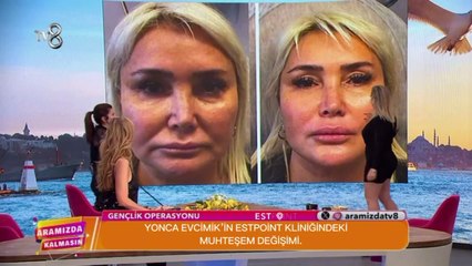 Yonca Evcimik Gel Konuşalım'da Estelift Uygulaması