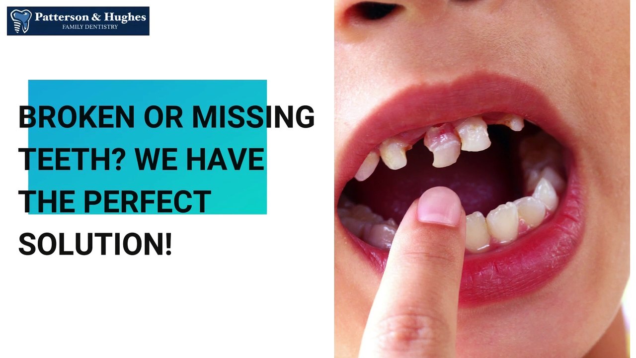 Broken or missing teeth We have the perfect solution! | Patterson & Hughes Family Dentistry | Emergency Dentist Near Me in Dalton