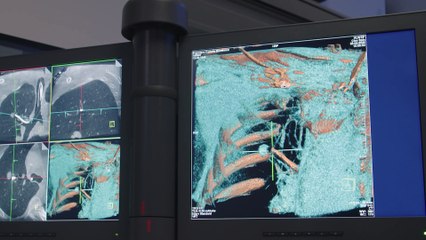 Llega a España una instalación única en el sur de Europa para diagnosticar nódulos pulmonares