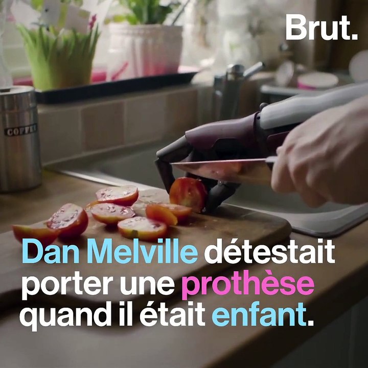 Né sans bras droit, Dan Melville vit avec un "bras bionique"