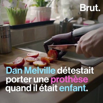 Né sans bras droit, Dan Melville vit avec un bras bionique