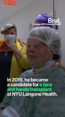 World's first face and hands transplant