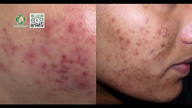 Điều trị thâm mụn chuẩn y khoa - Phòng khám Doctor Acnes