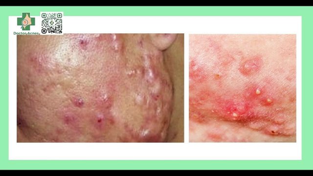 Mụn mạch lươn là gì? Dấu hiệu nhận biết và cách điều trị