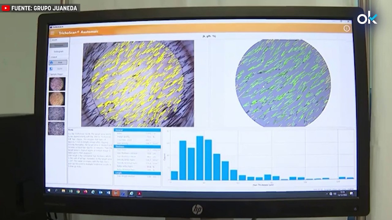 "La electroporación es el tratamiento más rápido y seguro para la fibrilación auricular, la arritmia más frecuente"