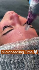 microneedling in Dubai