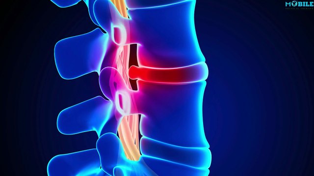 Slipped Disc: Sciatica, Back Pain & How to Heal Naturally