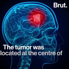 Man Recites Quran During Brain Surgery