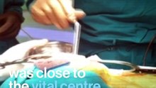 Man recites Hanuman Chalisa during brain surgery