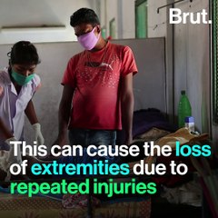 Leprosy Has Made A Comeback in India