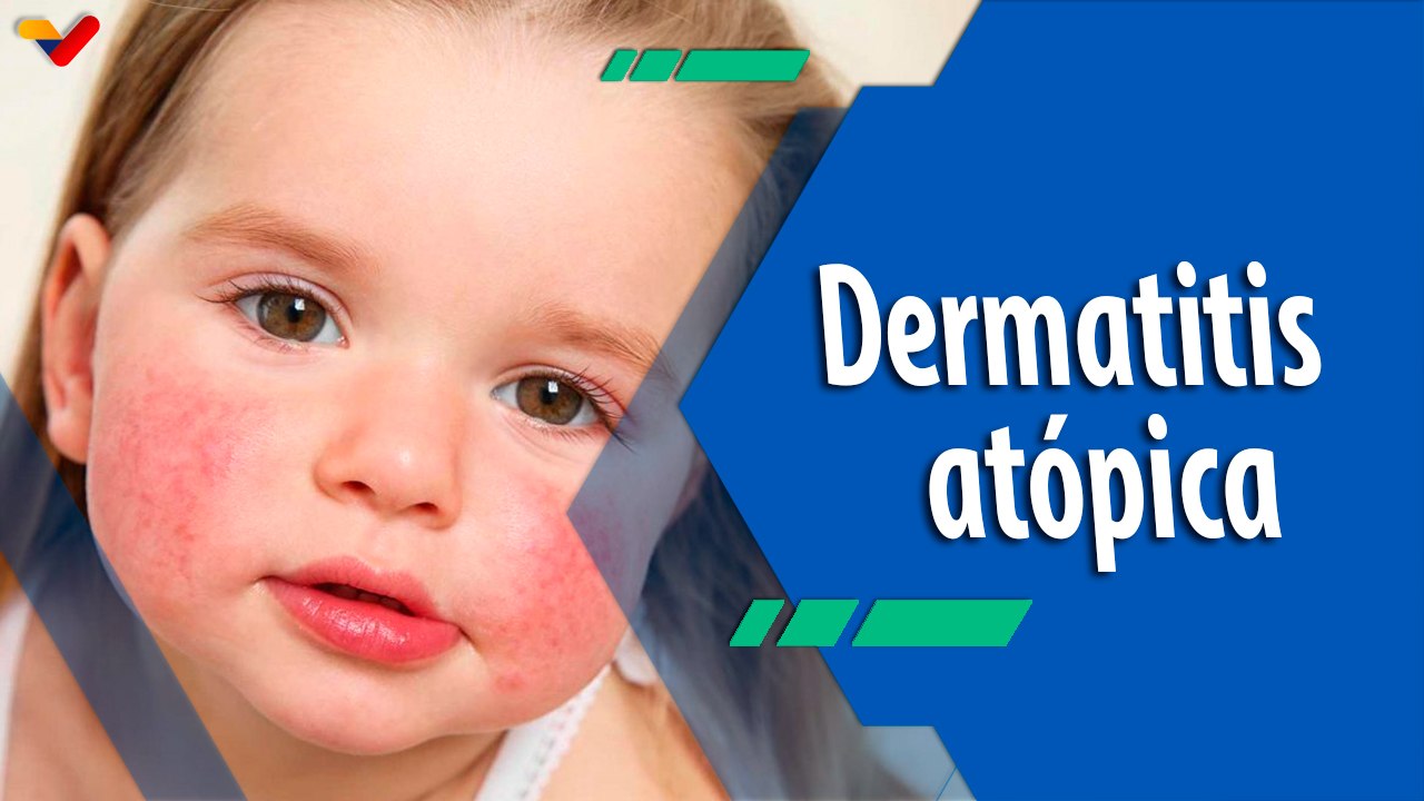 Actitud Saludable | Dermatitis Atópica: Causas, síntomas y cuidados esenciales