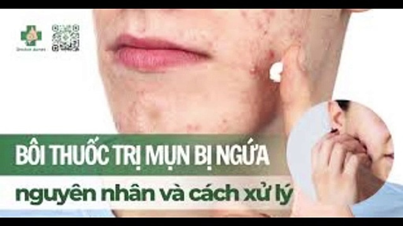 Bôi thuốc trị mụn bị ngứa: nguyên nhân và cách xử lý