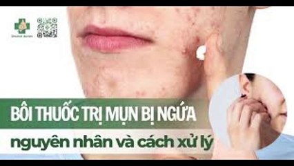 Bôi thuốc trị mụn bị ngứa: nguyên nhân và cách xử lý