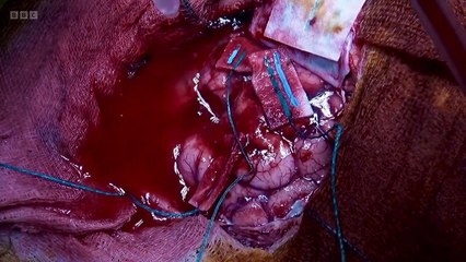 Surgeons: At the Edge of Life episode 11