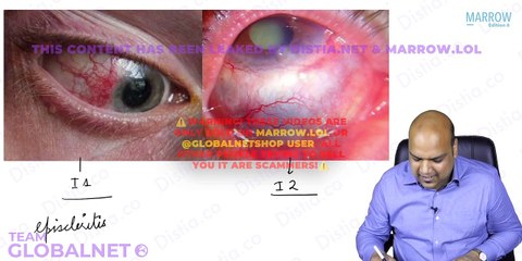 03. Anatomy of eye - sclera and it’s pathologies,Limbus and Ocular routes of drug administration