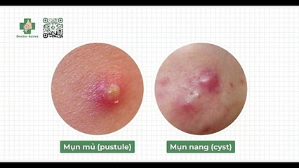 Mụn trứng cá có mùi hôi: nguyên nhân và cách điều trị