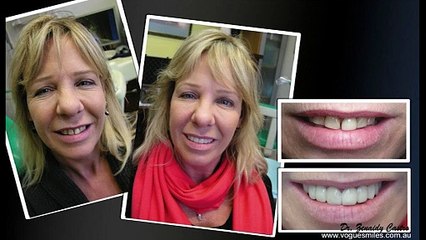 Smile Makeovers Dentistry and Cosmetic Dentistry by VOGUE SMILES MELBOURNE