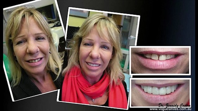 Smile Makeovers Dentistry and Cosmetic Dentistry by VOGUE SMILES MELBOURNE
