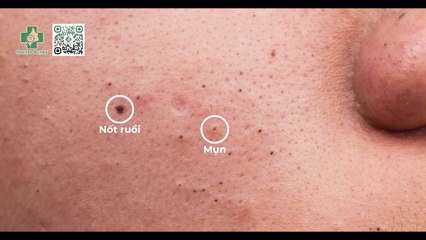 Mụn để lâu không nặn có thành nốt ruồi không?