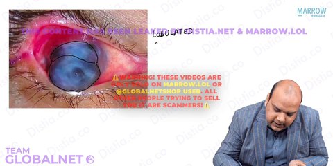 31. Cornea - Corneal ulcers and keratitis