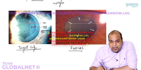 20. Glaucoma - Secondary glaucoma and Congenital glaucoma