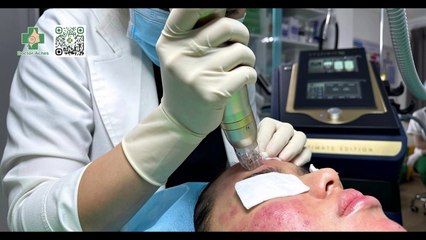 10 cách trị sẹo lõm trên trán giúp lấy lại làn da mịn màng