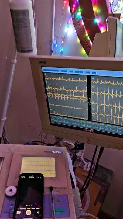 ÉLECTROCARDIOGRAMME D UNE HYPERTROPHY VENTRICULAIRE GAUCHE  SE NORMALISE A L EFFORT