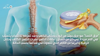 قولي وداعاً لآلام "عِرق النسا"