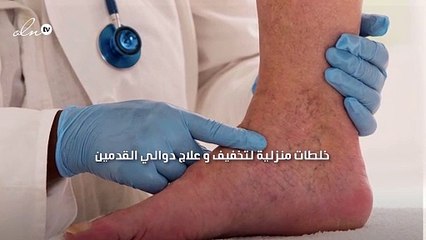6 خلطات منزلية لتخفيف و علاج دوالي القدمين