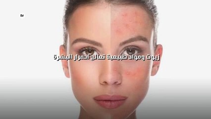 زيوت ومواد طبيعية تعالج احمرار البشرة