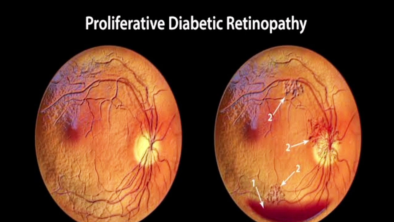 GSVM MEDICAL COLLEGE NEWS: Retinopathy can be reduced with a needle, what is retinopathy, Professor Dr. Parvez Khan told the results after the research