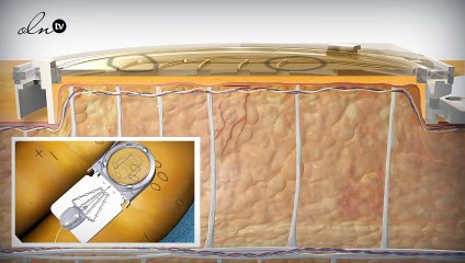 زويا تعرّفك على تجربتها مع علاج Cellfina للسلوليت لدى كلينيكا جويل