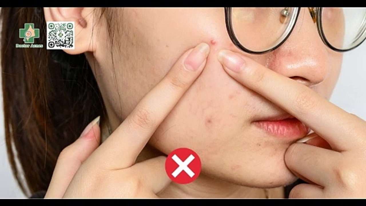 Trong kỳ kinh nguyệt có nên nặn mụn không? Sự thật bạn cần biết