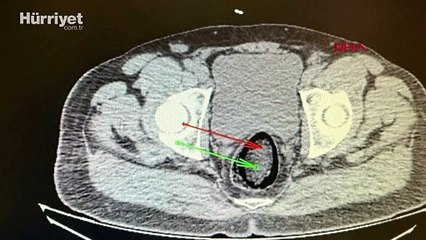 İranlı yolcunun makatından uyuşturucu çıktı